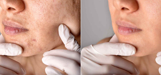 Understanding Acnes